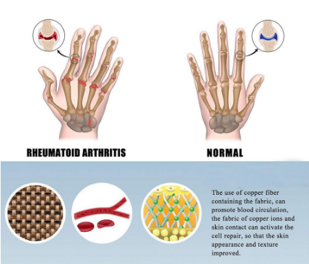 The Best Arthritis Compression Gloves